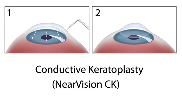 Chart Illustrating the Conductive Keratoplasty (NearVision CK) Process