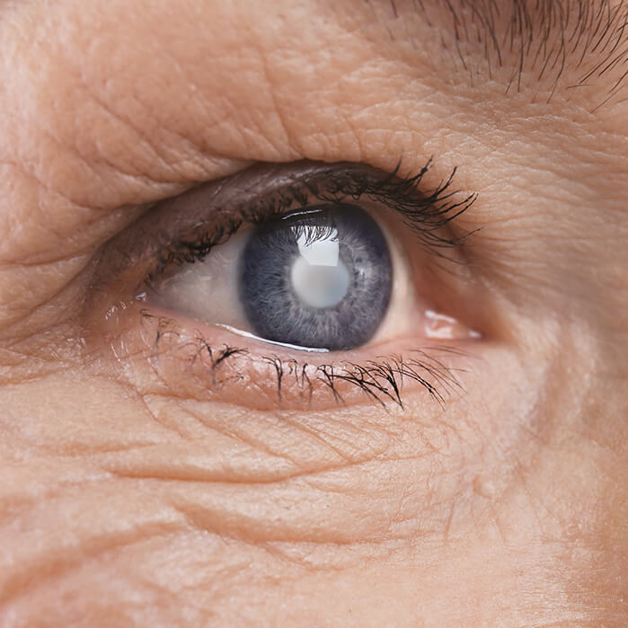 Closeup of a Cataract in an Eye