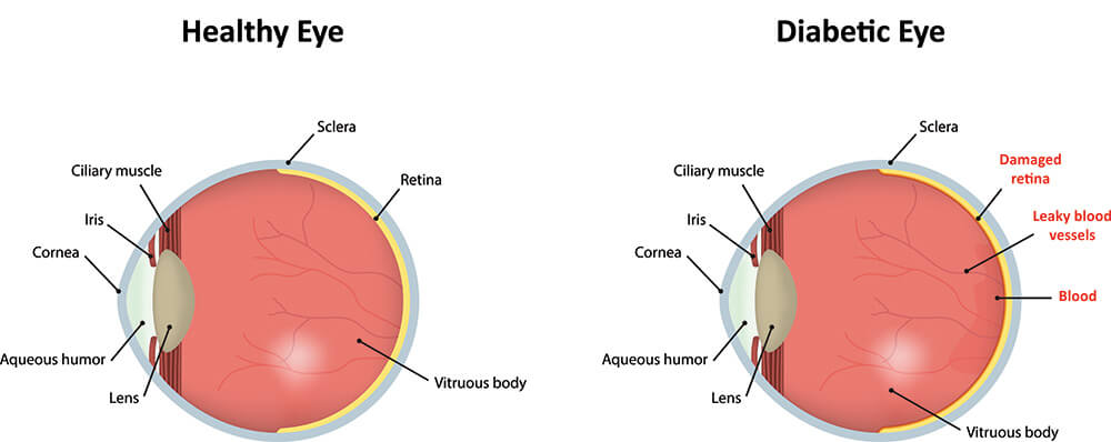 Chart Illustrating a Healthy Eye Vs One Experiencing Diabetic Retinopathy