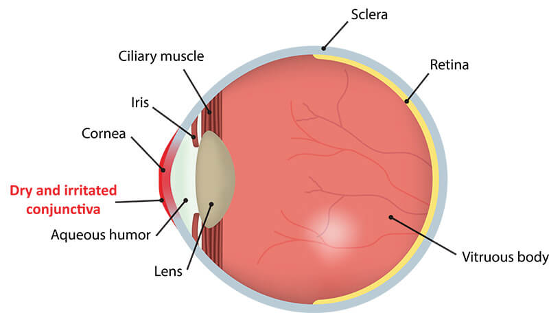 Chart Illustrating How Dry Eye Affects an Eye