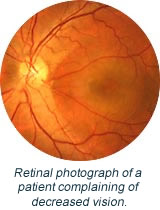 Retinal photograph of a patient complaining of decreased vision