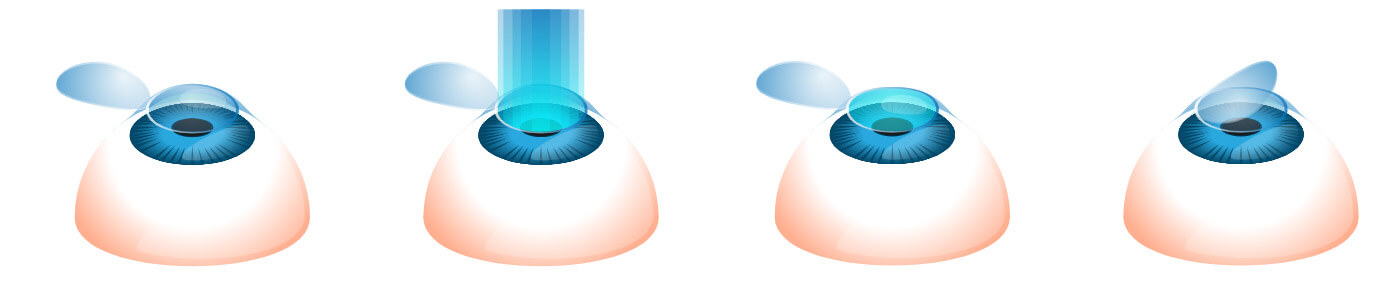 Lasik Methods LASIK Houston | LASIK Eye Surgery Houston