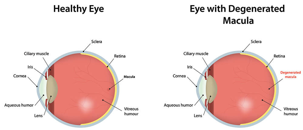 Chart Illustrating How Macular Degernation Affects an Eye