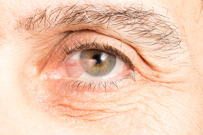 Closeup of a Pterygium in an Eye